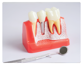 Dental Implants